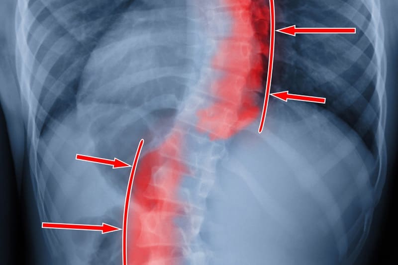 Escoliosis